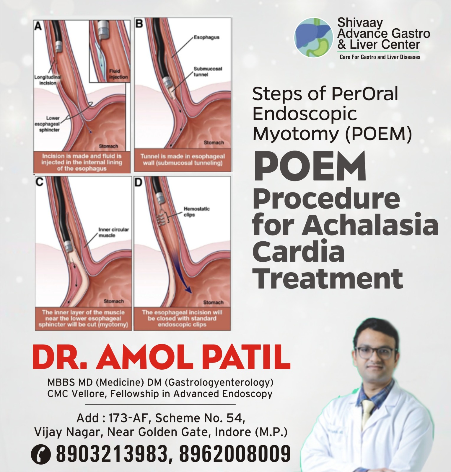 Doctor For Peroral Endoscopic Myotomy Treatment in Indore